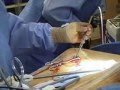 Coronary Bypass Surgery - MedStar Union Memorial Hospital