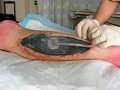 Part 2 - Brad's Surgery- The Skin Graft