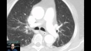 Ct Lll Atelectasis Discussed By Radiologist