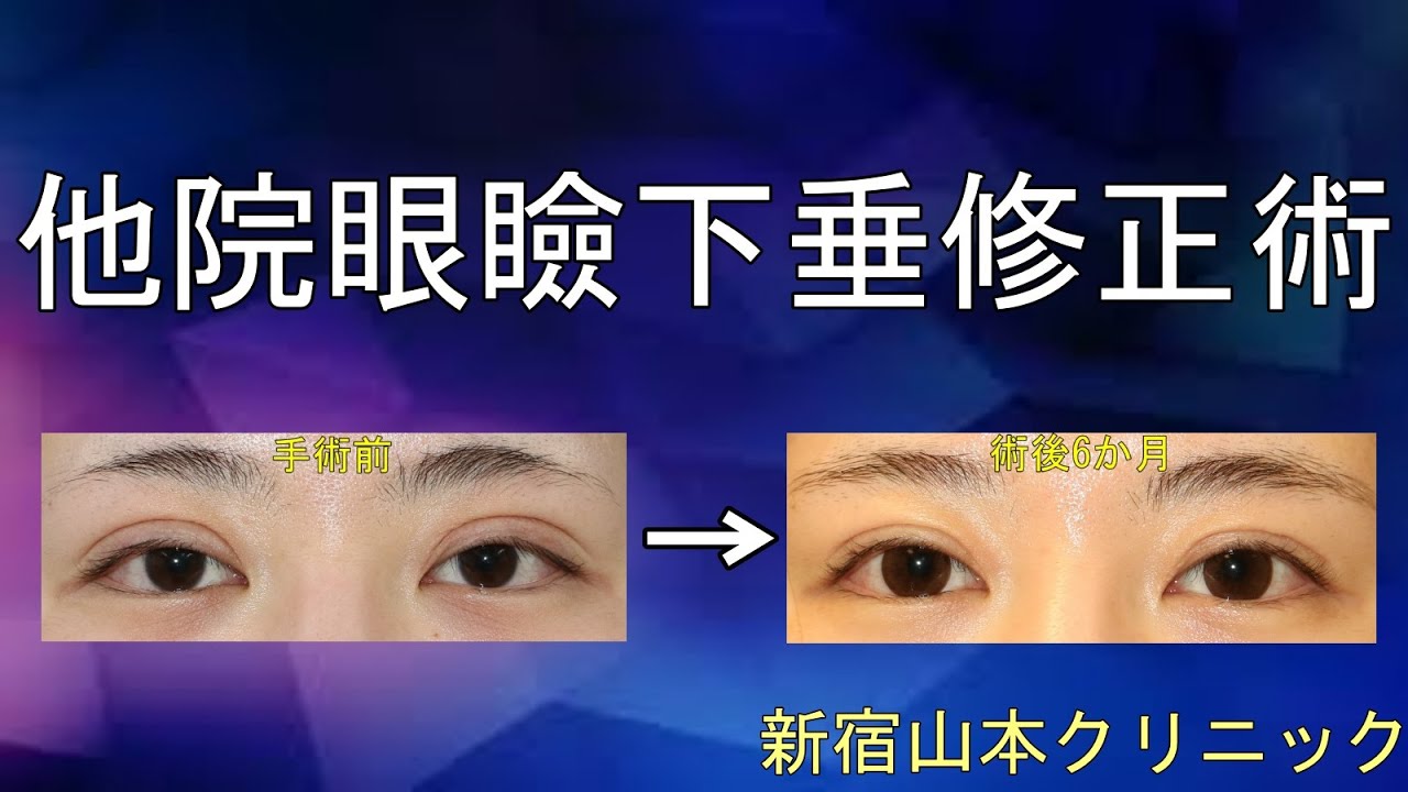 眠たそうな目を修正する!! 山本クリニック