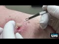 Back Blackhead Extraction Session 2 In Mrs Gold Addressing Inflamed Back Blackhead Extraction Session 2 In Mrs Gold Addressing Inflamed