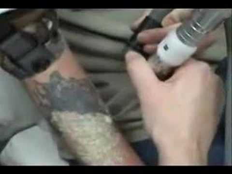 Laser Tattoo Removal