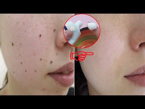 Cách Tẩy Nốt Ruồi, Tàn Nhang Tại Nhà Không Để Lại Sẹo - Cách Tự Tẩy Mụn Ruồi Hiệu Quả