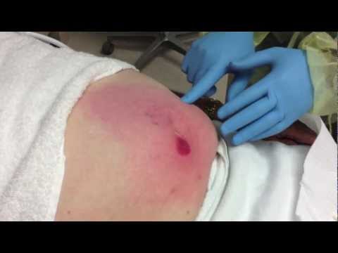 abscess with complicated cellulitis