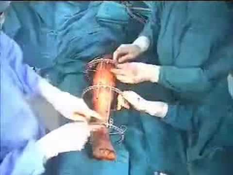 LON - Part 2, Lengthening over a nail for a case of tibial hemimelia, 