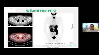 21-01. Dr Nat Lenzo "Radioligand Guided Imaging and Therapy in Prostate Cancer" Jan 28, 2021