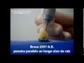 ACESSO RADICULAR canino.wmv