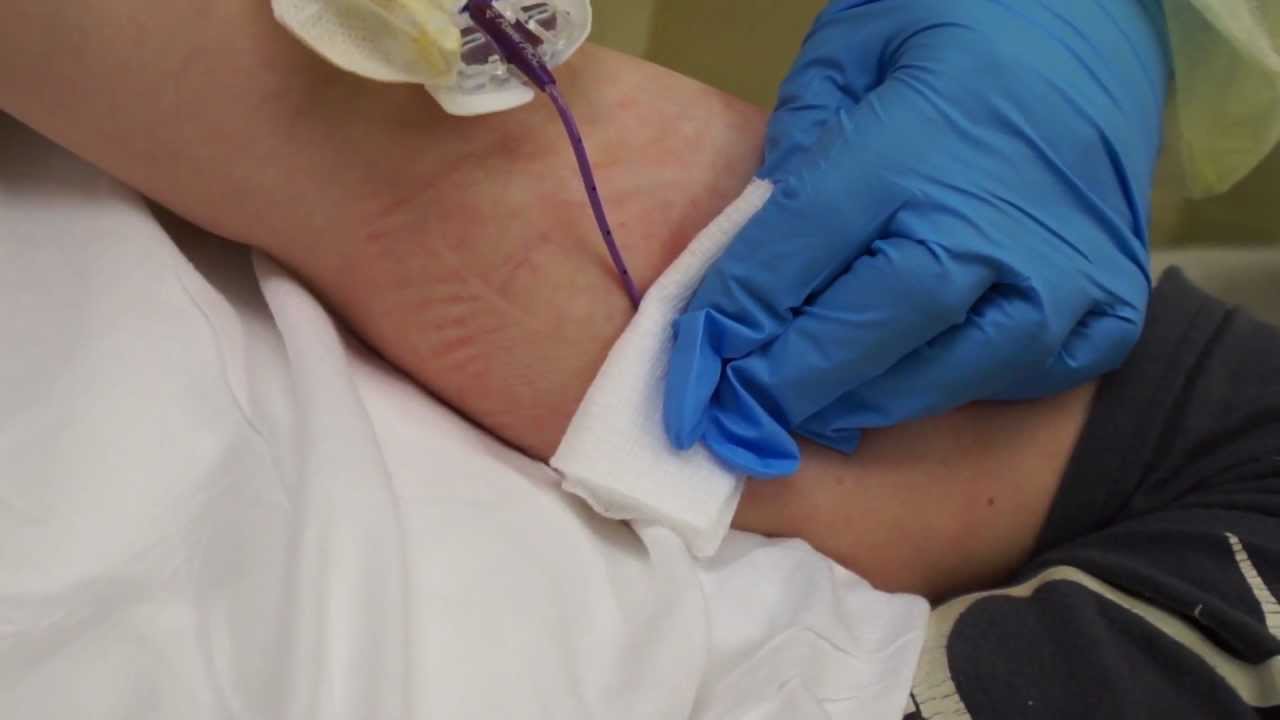 AmputeeOT: PICC line removal - YouTube