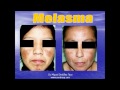 MANCHAS DE LA PIEL EN GUAYAQUIL (MELASMA)