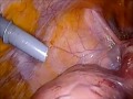 Simposia Mentor Series I: Laparoscopic Hysterectomy on Large Uterus