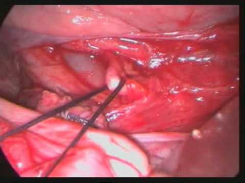 Internal Iliac artery ligation.Dr.Abdul Wahab - YouTube