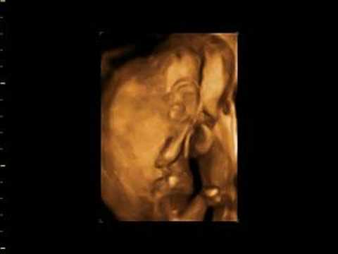 3d ultrasound scan. 3D and 2D Ultrasound 19 week
