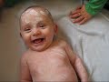Chicken pox!