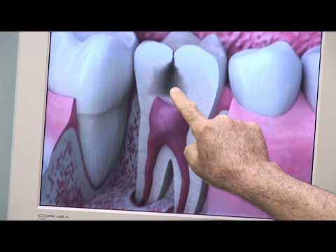 Dental Health Gum Disease : What Does a Cavity Look Like?