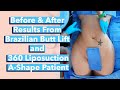 Before and After Results From Brazilian Butt Lift (BBL) and 360 Liposuction! A-Shape Patient!