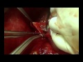 FIGO 2012: LIVE SURGERY Advanced Ovarian Cancer Part.1