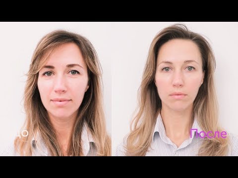 Хиромассаж лица (до и после процедуры) Хиромассаж лица (до и после процедуры)