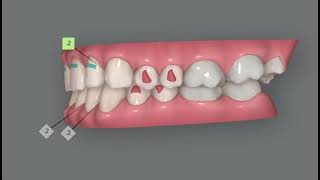 Invisalign Clincheck Simulation. Correction Of Deep Bite And Traumatic Occlusion. Delicate Case.