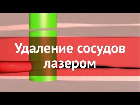 Лазерное удаление капилляров и сосудов Лазерное удаление капилляров и сосудов