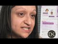 Primary Rhinoplasty Surgery Before and After
