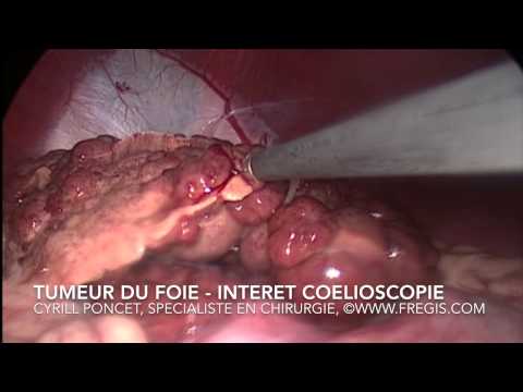 Most cancers poumon segment terminale combien de temps tumeur qui se necrose