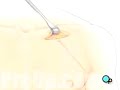 Malpractice Medical Permanent Pacemaker Implant Surgery* 3
