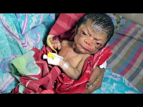 Shocking Face Of Newborn Baby Who Looks 80-years-old