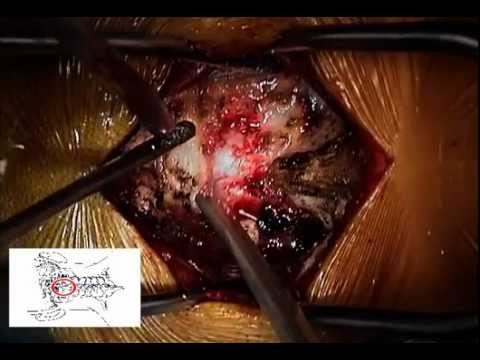 chiari malformation arnold surgery decompression 1i procedure