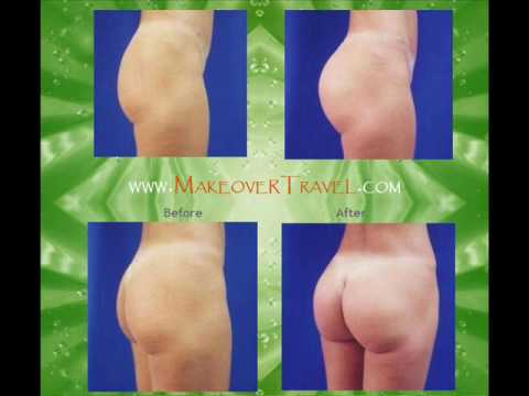 buttock implants before and after. Buttock Lift / Buttock