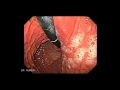 Endoscopy