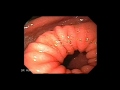 Endoscopy