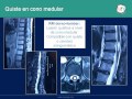 Neurorgs.net-Quiste del cono medular