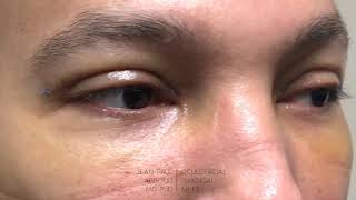 Upper Eyelid Blepharoplasty: One Week After Surgery