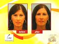 DALLAS FACE LIFT ALTERNATIVE:  NO-INCISION PLASTIC SURGERY