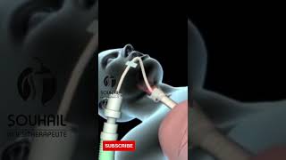 Tracheal Intubation