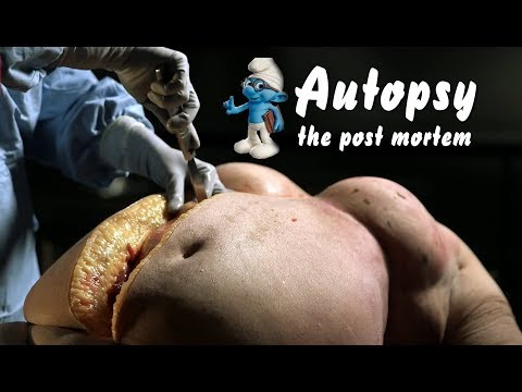 Obese Autopsy : The Post Mortem