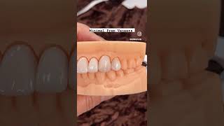 Minimal Prep Veneers