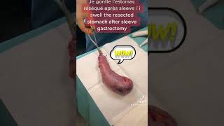 Resected stomach after sleeve gastrectomy / estomac réséqué après sleeve