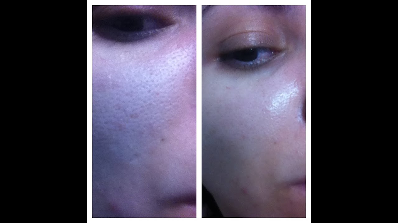 qual melhor peeling para manchas
