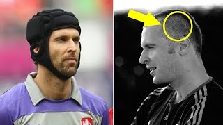 Do you know why Petr Cech wearing a helmet on his head ?