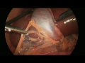 Laparoscopic Cholecystectomy (Gallbladder) Surgery