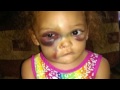 Little girl repeatedly 'kicked in the face' while at school