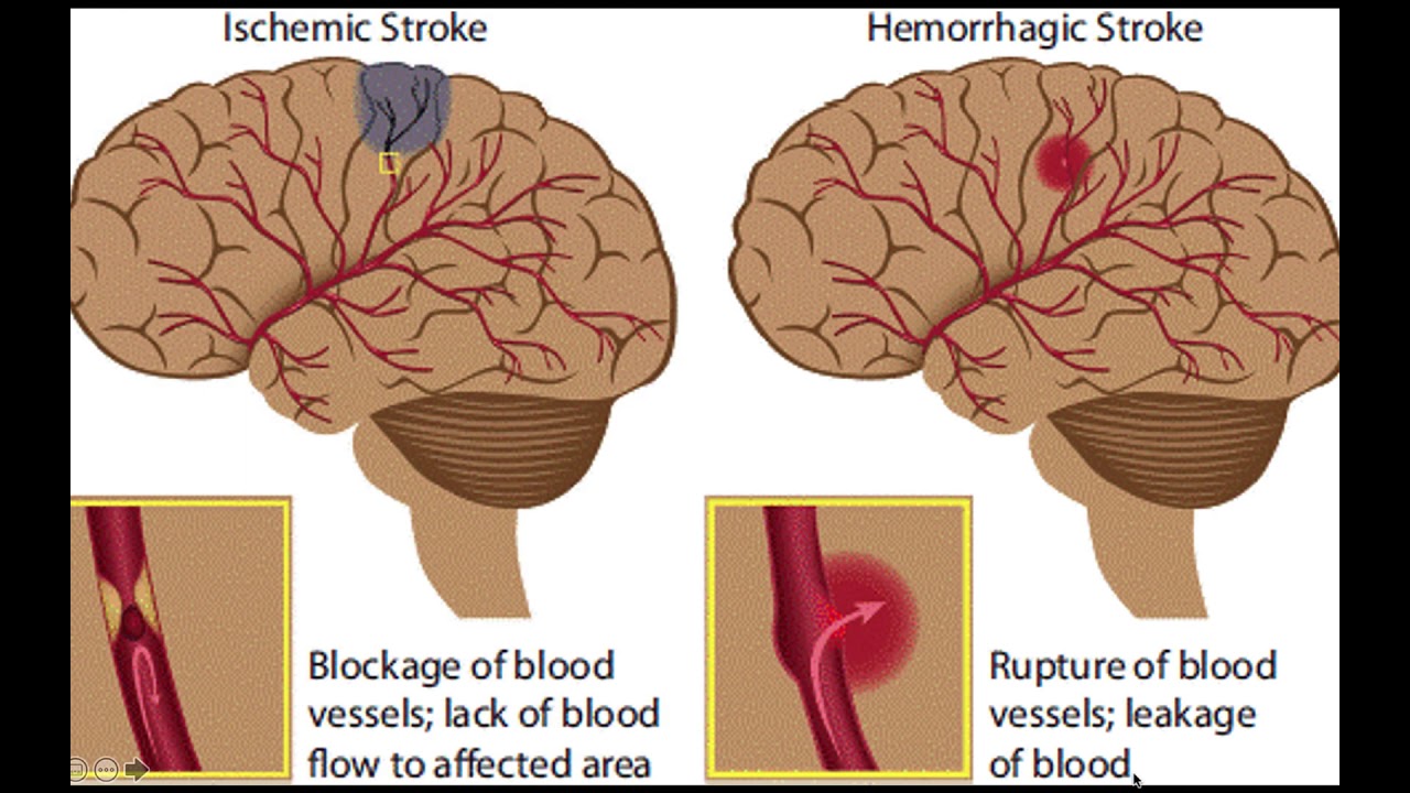 Stroke encouragement