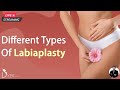 Different Types Of Labiaplasty