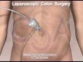 Colon Surgery