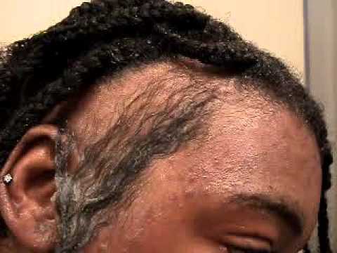 Hair Growth Remedies on Hair Restoring With Onion