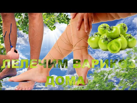 Внутренний варикоз лечить в домашних условиях