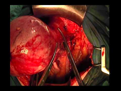 Fibroid Specialist In Palm Beach Fl Fibroid Specialist In Palm Beach Fl
