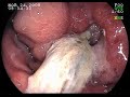 Gastric ulcer follow up TACE