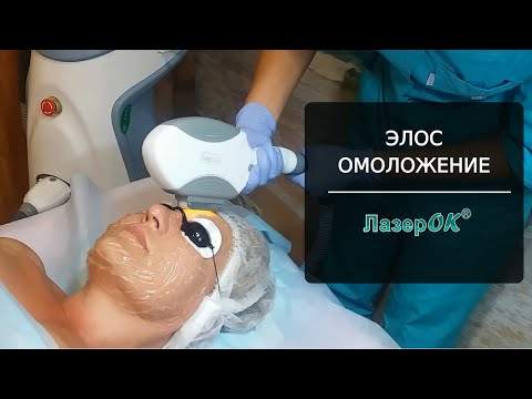 Отзывы о процедуре элос омоложение Отзывы о процедуре элос омоложение